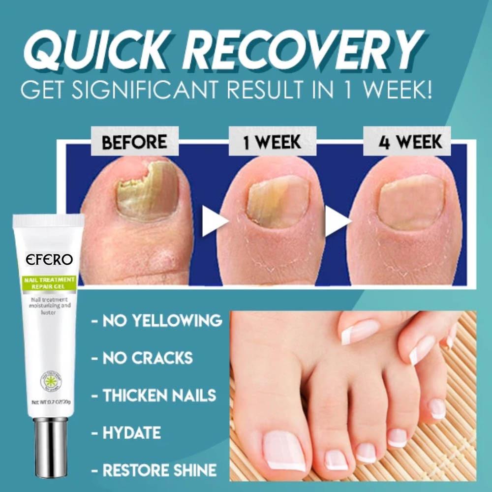 NailForce™ — Vernichte Pilze & entfessele die unbesiegbare Power deiner Nägel in nur 7 Tagen!