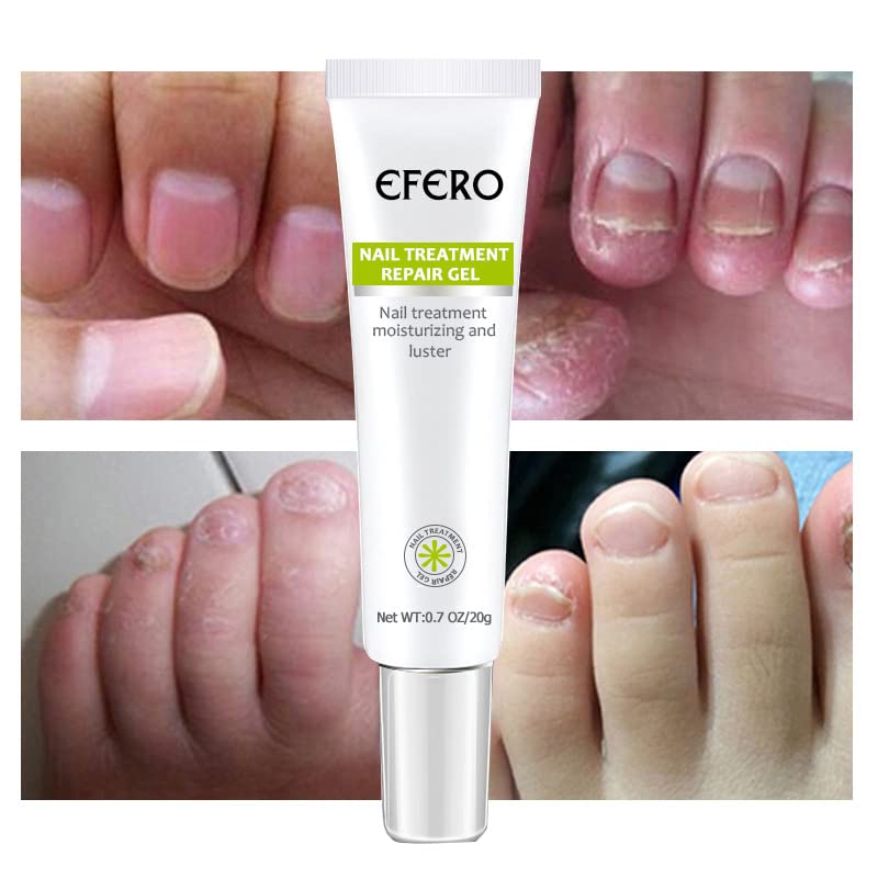 NailForce™ — Vernichte Pilze & entfessele die unbesiegbare Power deiner Nägel in nur 7 Tagen!