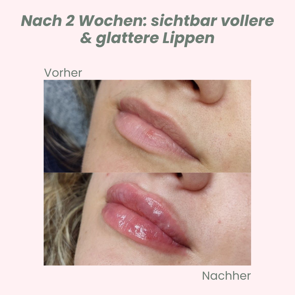 VoluPout™ — Verführerische, pralle Lippen ohne Nadeln in Minuten