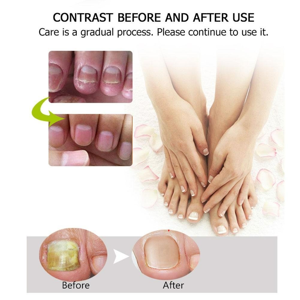 NailForce™ — Vernichte Pilze & entfessele die unbesiegbare Power deiner Nägel in nur 7 Tagen!