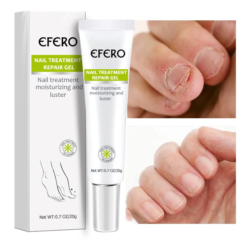 NailForce™ — Vernichte Pilze & entfessele die unbesiegbare Power deiner Nägel in nur 7 Tagen!