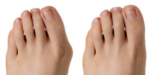 Flex-Ballenzehkorrektor - Rette deinen Zeh bevor es zu spät ist!