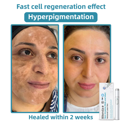 ClearSkinPro™ — Schmerzfrei zu makelloser Haut, die jeden Spiegel zum Freund macht