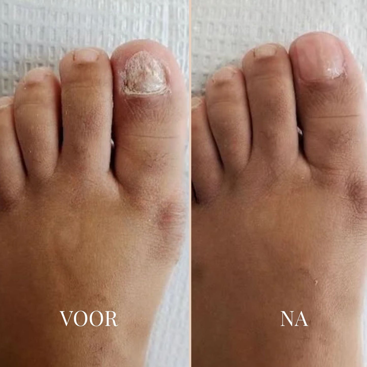 NailVibe Repair Patches — Endlich selbstbewusst nackte Füße zeigen ohne Scham!