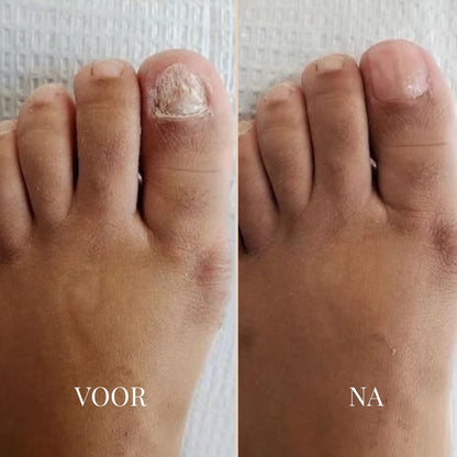 NailVibe Repair Patches — Endlich selbstbewusst nackte Füße zeigen ohne Scham!