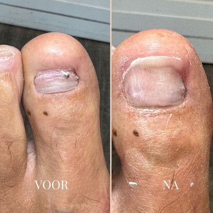 NailVibe Repair Patches — Endlich selbstbewusst nackte Füße zeigen ohne Scham!