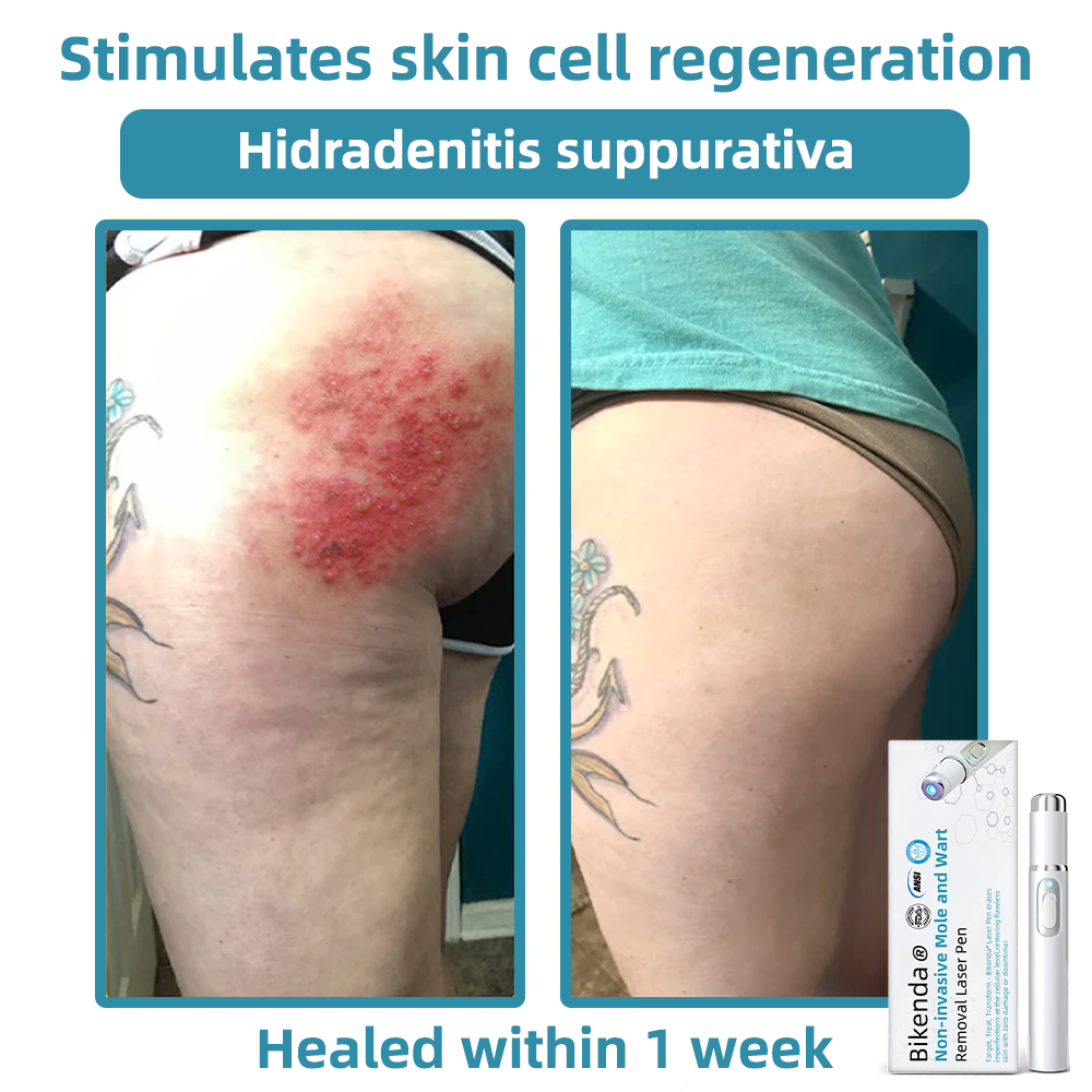 ClearSkinPro™ — Schmerzfrei zu makelloser Haut, die jeden Spiegel zum Freund macht