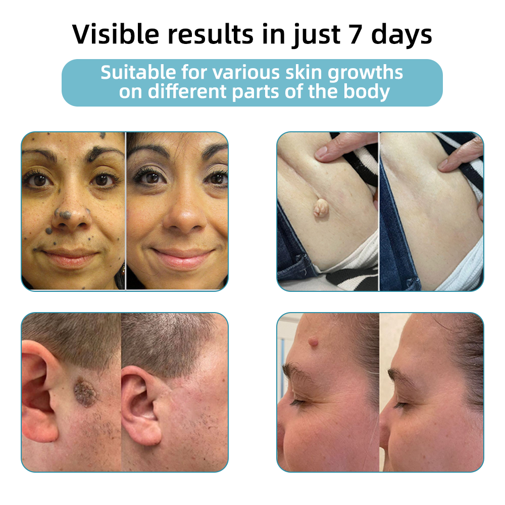 ClearSkinPro™ — Schmerzfrei zu makelloser Haut, die jeden Spiegel zum Freund macht