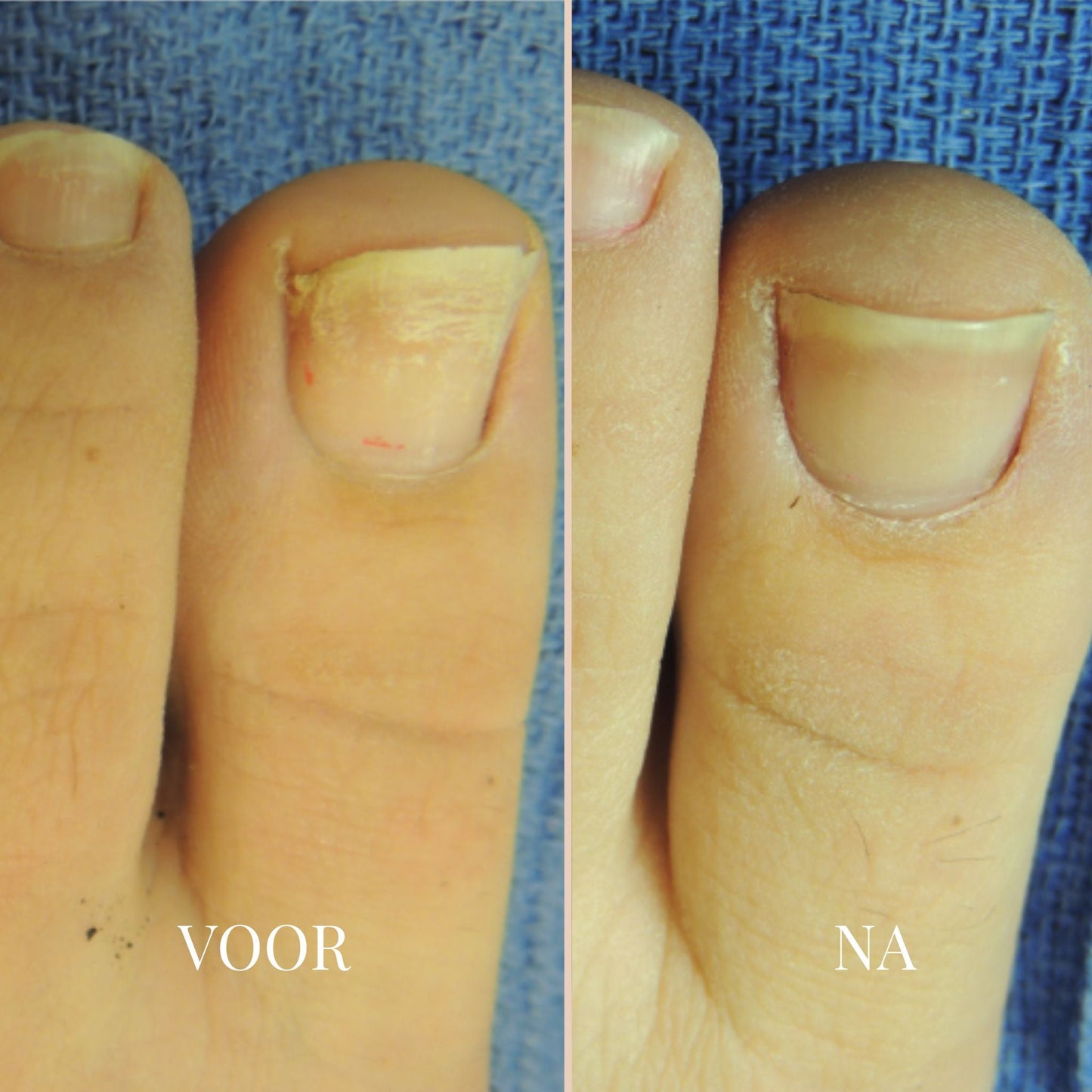 NailVibe Repair Patches — Endlich selbstbewusst nackte Füße zeigen ohne Scham!