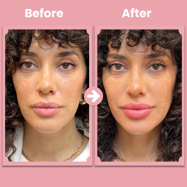 VoluPout™ — Verführerische, pralle Lippen ohne Nadeln in Minuten