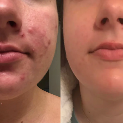 LumeniSkin — Mach Schluss mit Makeln und strahle Selbstbewusstsein aus!