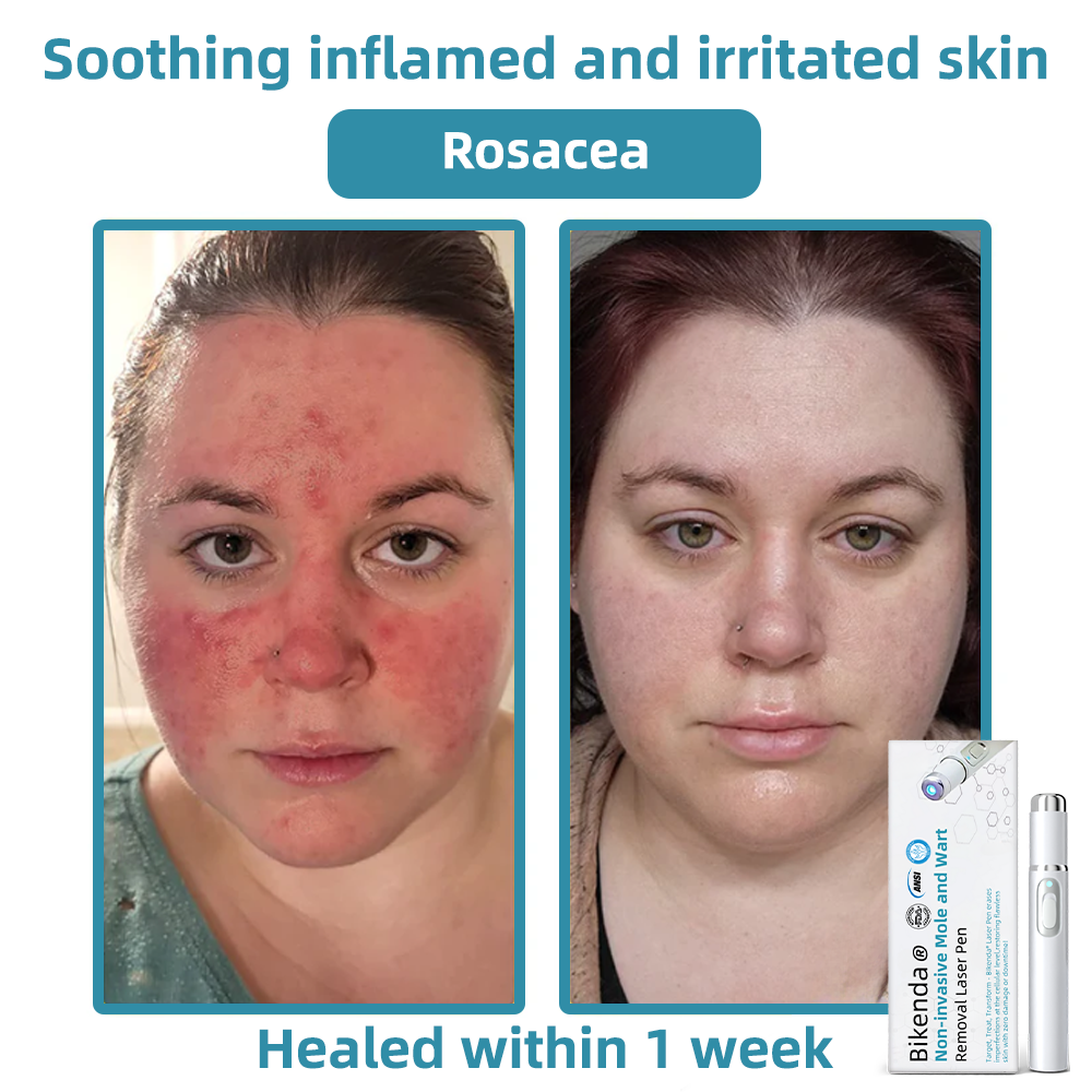 ClearSkinPro™ — Schmerzfrei zu makelloser Haut, die jeden Spiegel zum Freund macht