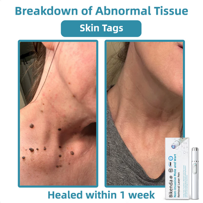 ClearSkinPro™ — Schmerzfrei zu makelloser Haut, die jeden Spiegel zum Freund macht