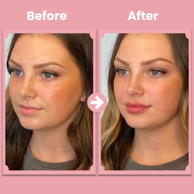 VoluPout™ — Verführerische, pralle Lippen ohne Nadeln in Minuten