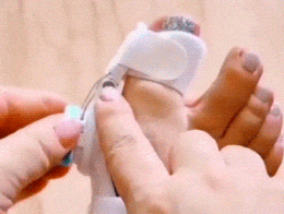 Flex-Ballenzehkorrektor Verstellbar - Rette deinen Zeh bevor es zu spät ist!